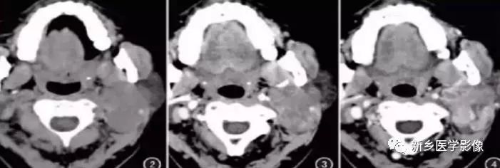 【病例】79岁男性腮腺和盆腔同时长肿瘤,怎么回事? 【病例】79岁男性腮腺和盆腔同时长肿瘤,怎么回事?