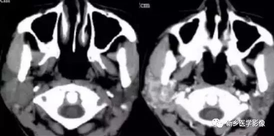 【病例】79岁男性腮腺和盆腔同时长肿瘤,怎么回事? 【病例】79岁男性腮腺和盆腔同时长肿瘤,怎么回事?
