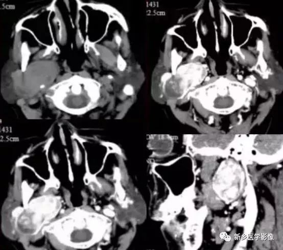 【病例】79岁男性腮腺和盆腔同时长肿瘤,怎么回事? 【病例】79岁男性腮腺和盆腔同时长肿瘤,怎么回事?