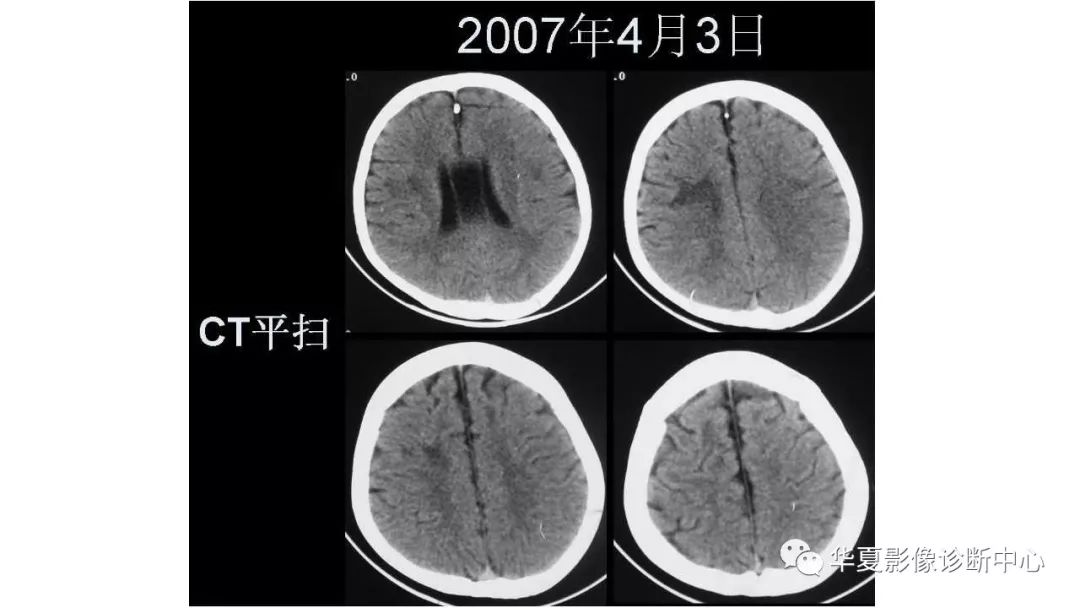 【病例】脑肿瘤样炎性脱髓鞘病1例CT及MR