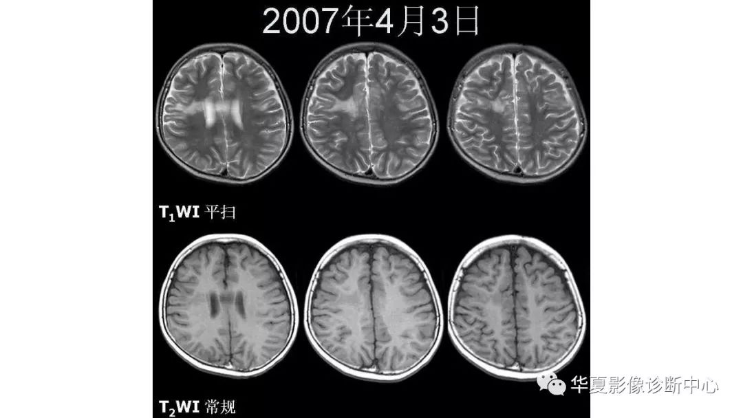 【病例】脑肿瘤样炎性脱髓鞘病1例CT及MR