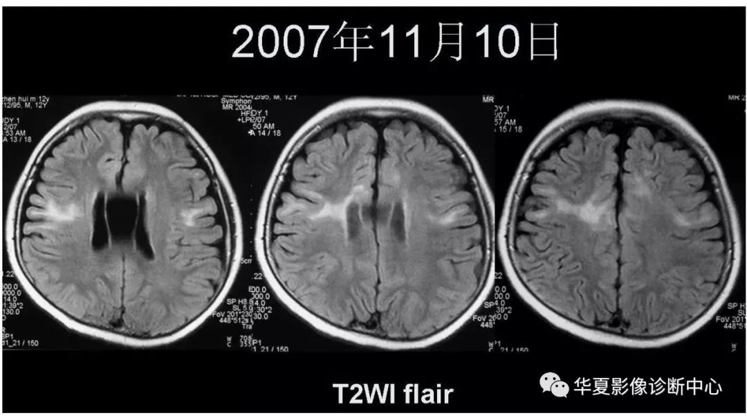 【病例】脑肿瘤样炎性脱髓鞘病1例CT及MR