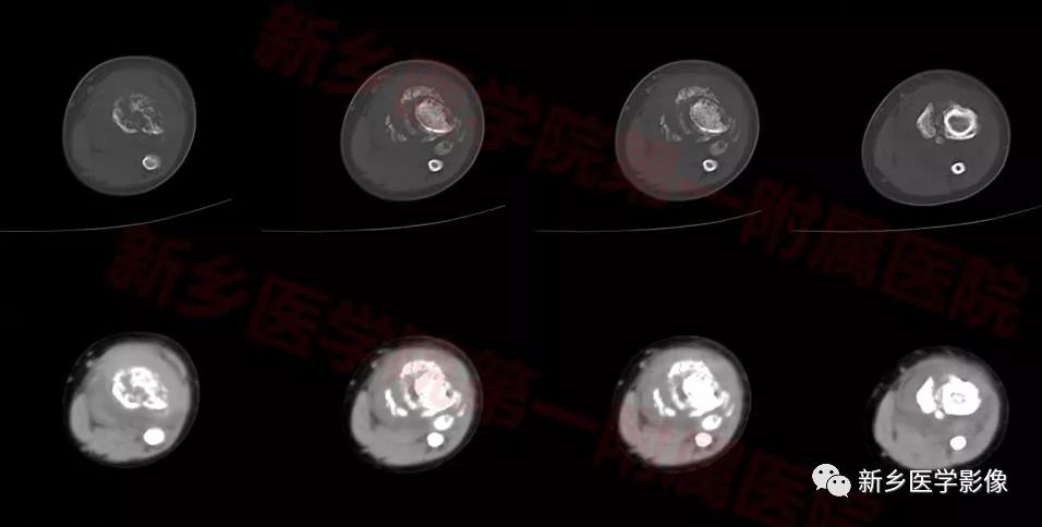 【病例】纤维骨性假瘤1例X线CT