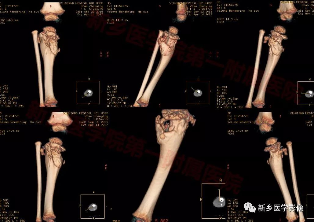 【病例】纤维骨性假瘤1例X线CT