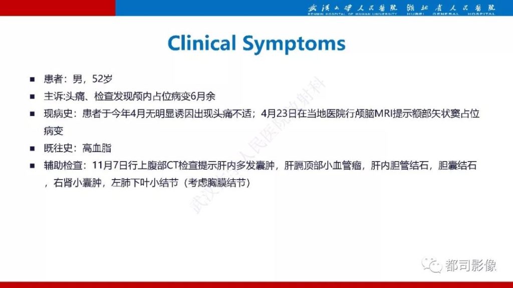 【病例】颅骨表皮样囊肿1例CT及MR影像诊断