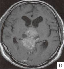 【病例】松果体母细胞瘤1例MR 【病例】松果体母细胞瘤1例MR