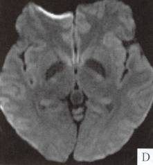 【病例】松果体囊肿1例MR 【病例】松果体囊肿1例MR