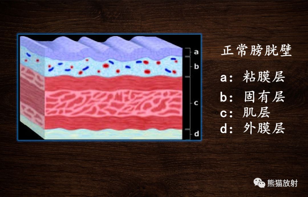 【PPT】膀胱疾病的影像学诊断