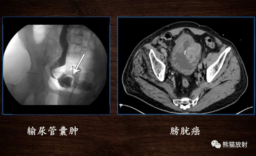【PPT】膀胱疾病的影像学诊断