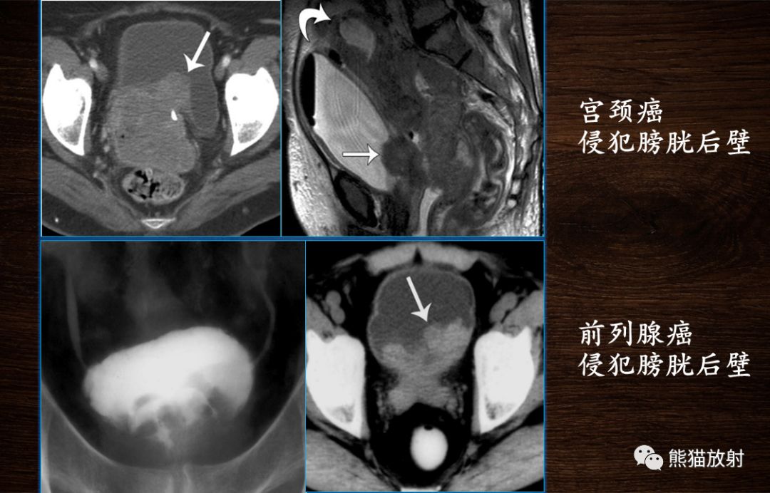 【PPT】膀胱疾病的影像学诊断