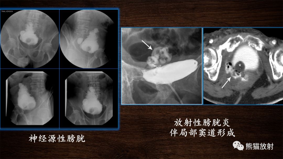【PPT】膀胱疾病的影像学诊断