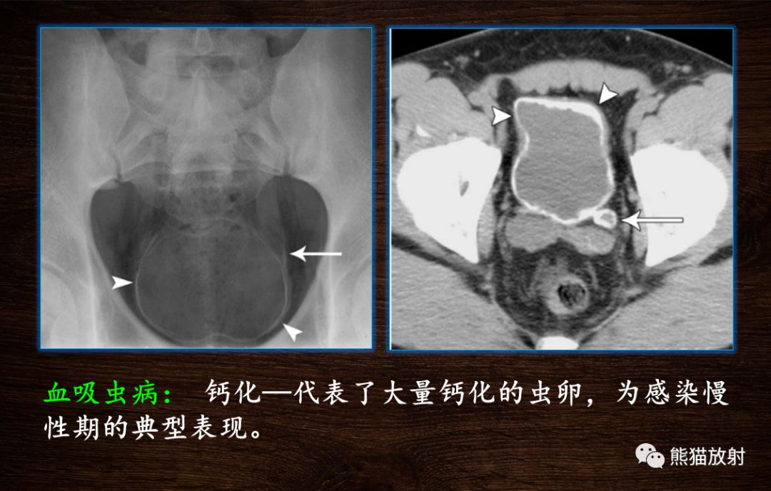 【PPT】膀胱疾病的影像学诊断