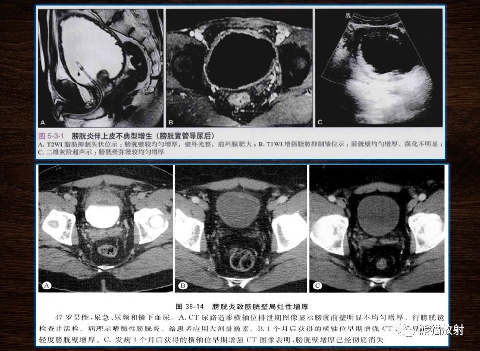 【PPT】膀胱疾病的影像学诊断
