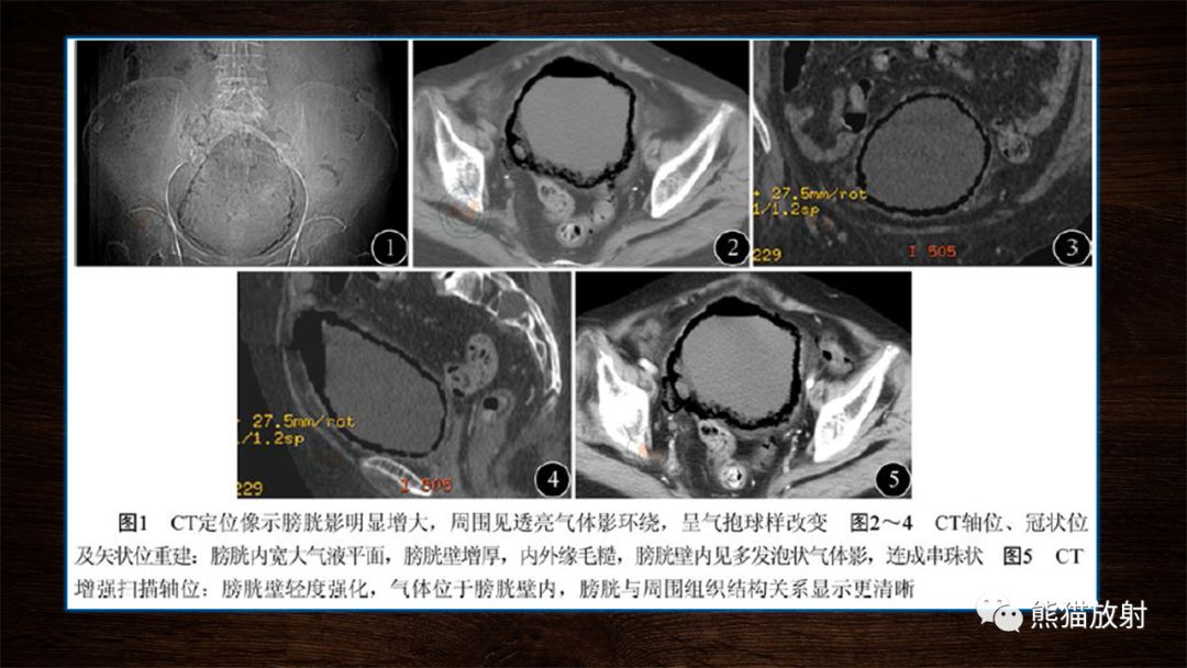 【PPT】膀胱疾病的影像学诊断