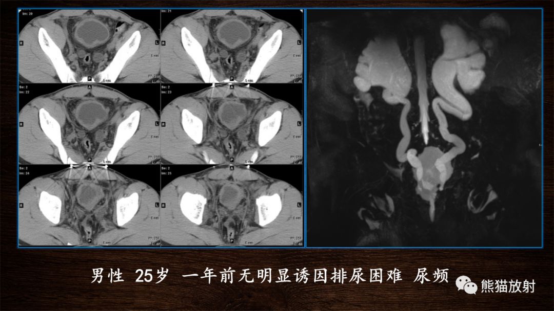 【PPT】膀胱疾病的影像学诊断