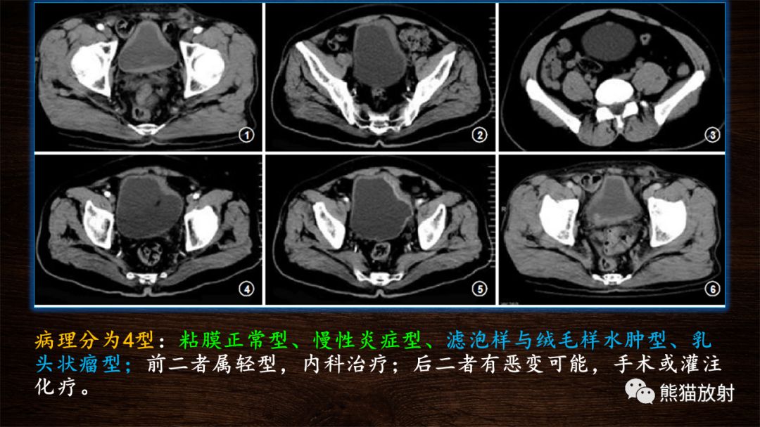 【PPT】膀胱疾病的影像学诊断