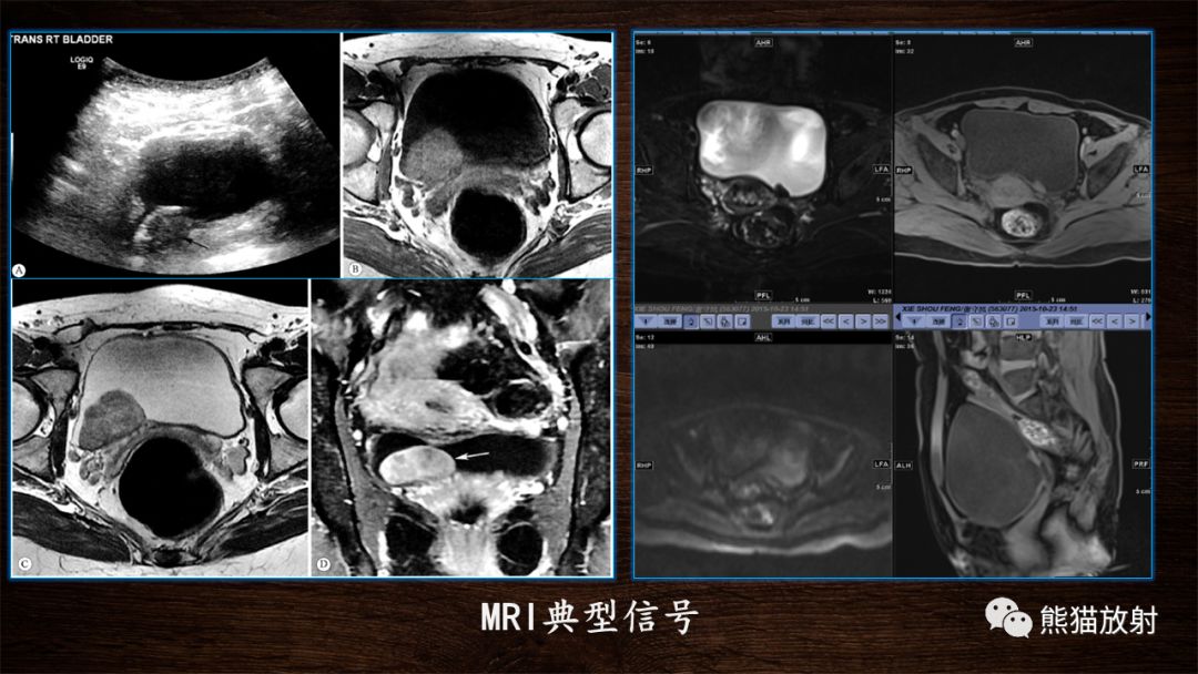 【PPT】膀胱疾病的影像学诊断