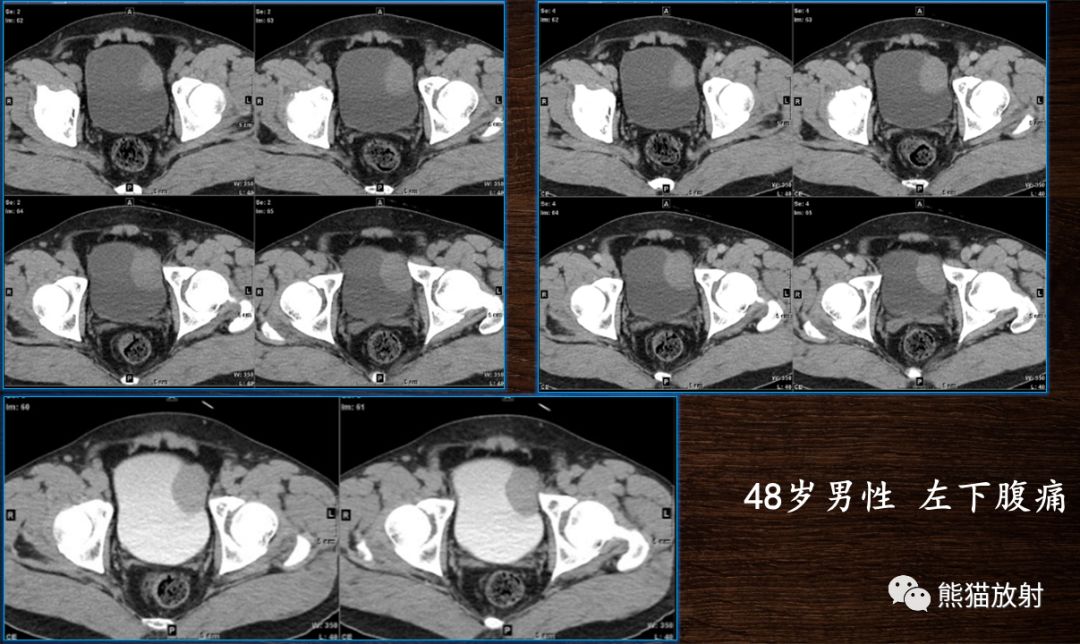 【PPT】膀胱疾病的影像学诊断