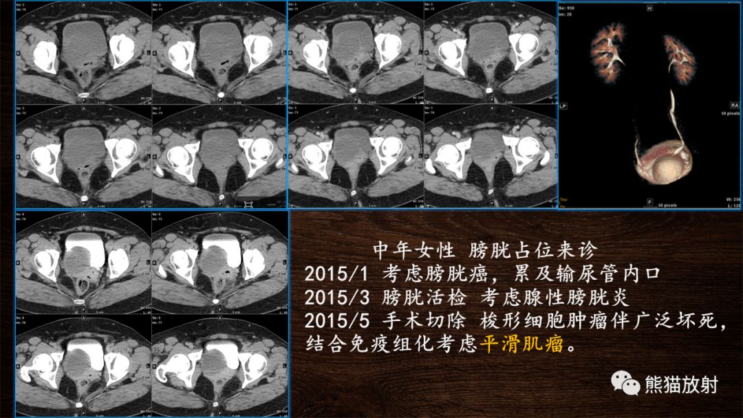 【PPT】膀胱疾病的影像学诊断