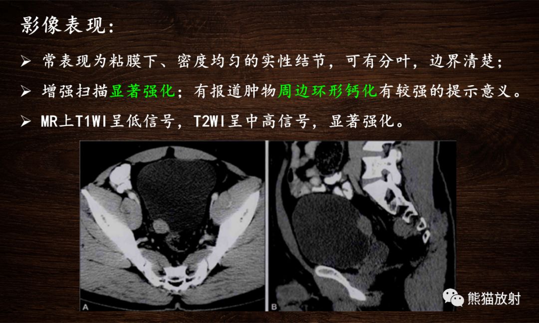 【PPT】膀胱疾病的影像学诊断