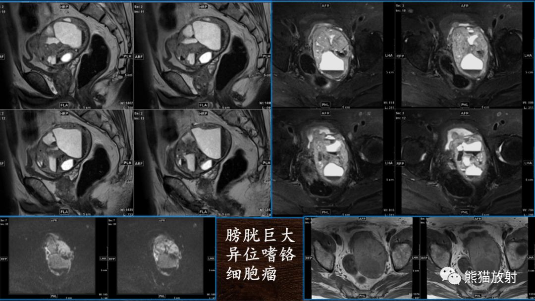 【PPT】膀胱疾病的影像学诊断
