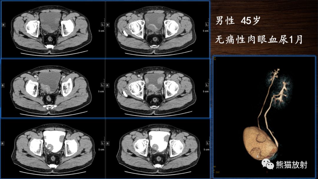 【PPT】膀胱疾病的影像学诊断