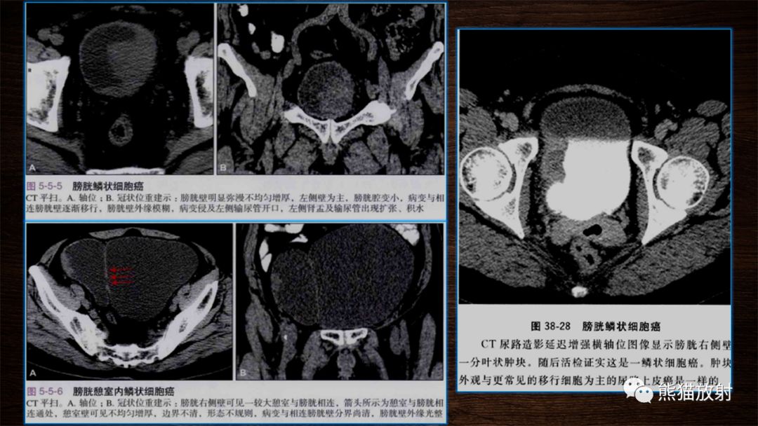 【PPT】膀胱疾病的影像学诊断