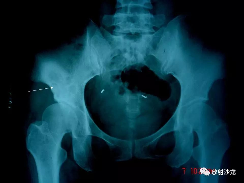 【病例】右侧髂骨软骨粘液性纤维瘤1例X线CT及MR