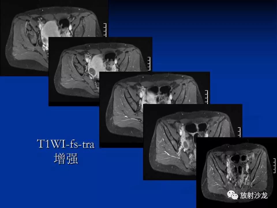 【病例】右侧髂骨软骨粘液性纤维瘤1例X线CT及MR