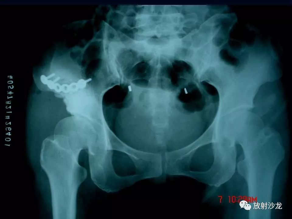 【病例】右侧髂骨软骨粘液性纤维瘤1例X线CT及MR
