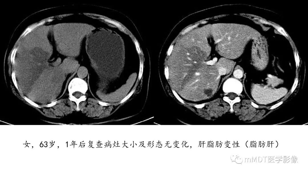 【PPT】常见含脂肪成分的肝脏“团块”