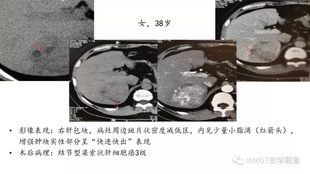 【PPT】常见含脂肪成分的肝脏“团块”
