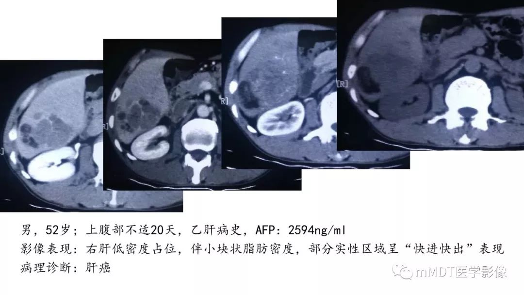 【PPT】常见含脂肪成分的肝脏“团块”