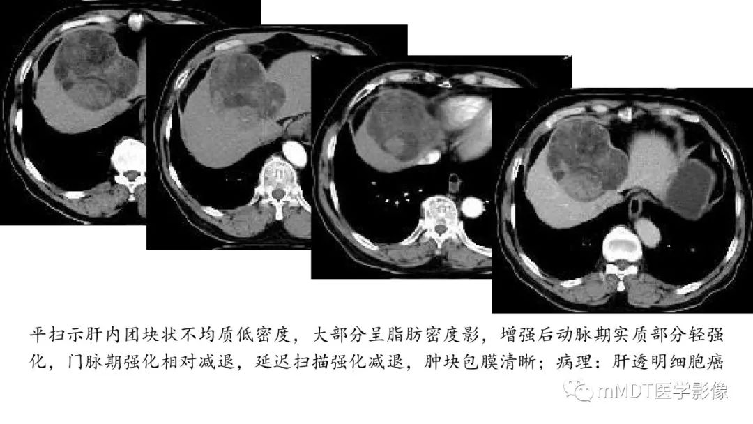 【PPT】常见含脂肪成分的肝脏“团块”