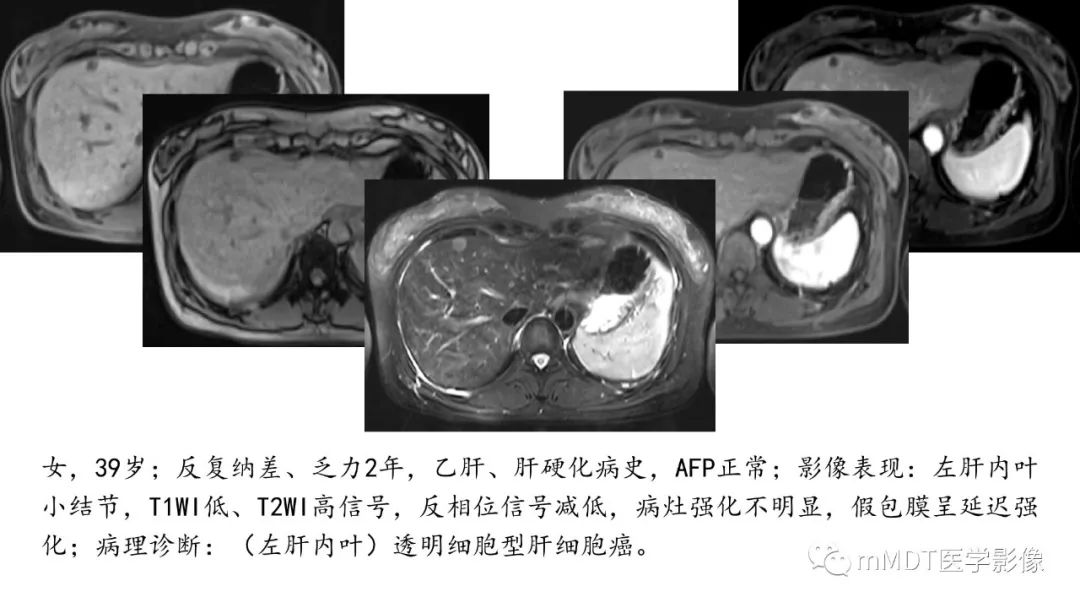 【PPT】常见含脂肪成分的肝脏“团块”