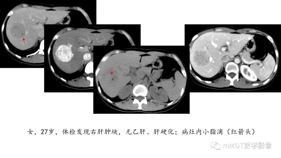 【PPT】常见含脂肪成分的肝脏“团块”
