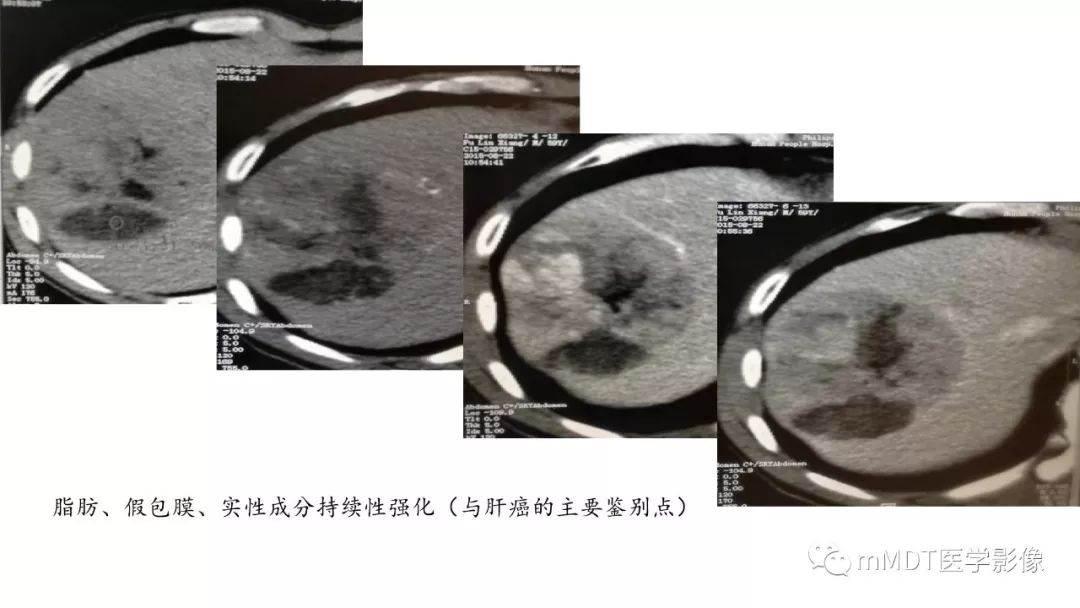 【PPT】常见含脂肪成分的肝脏“团块”