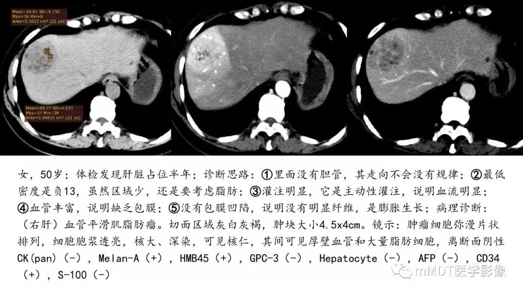 【PPT】常见含脂肪成分的肝脏“团块”