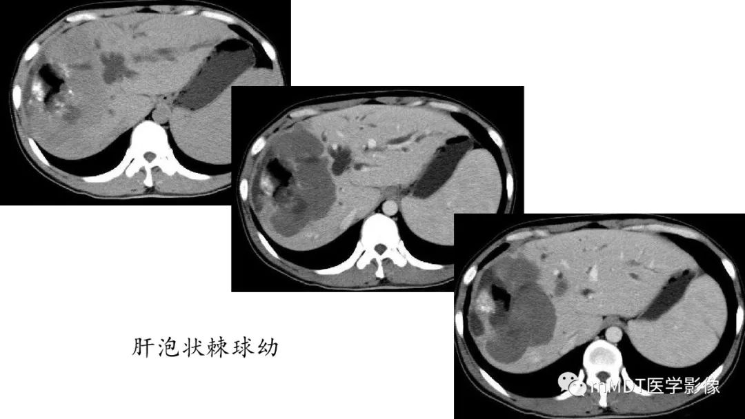 【PPT】常见含脂肪成分的肝脏“团块”