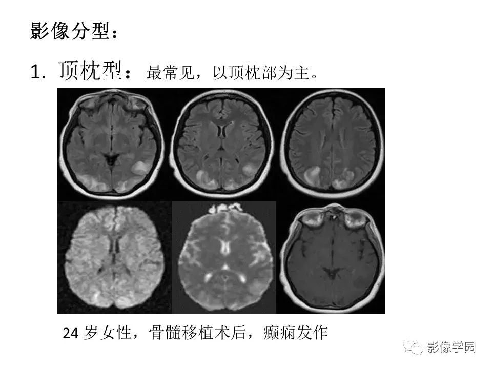 可逆性后部脑病综合征 PRES