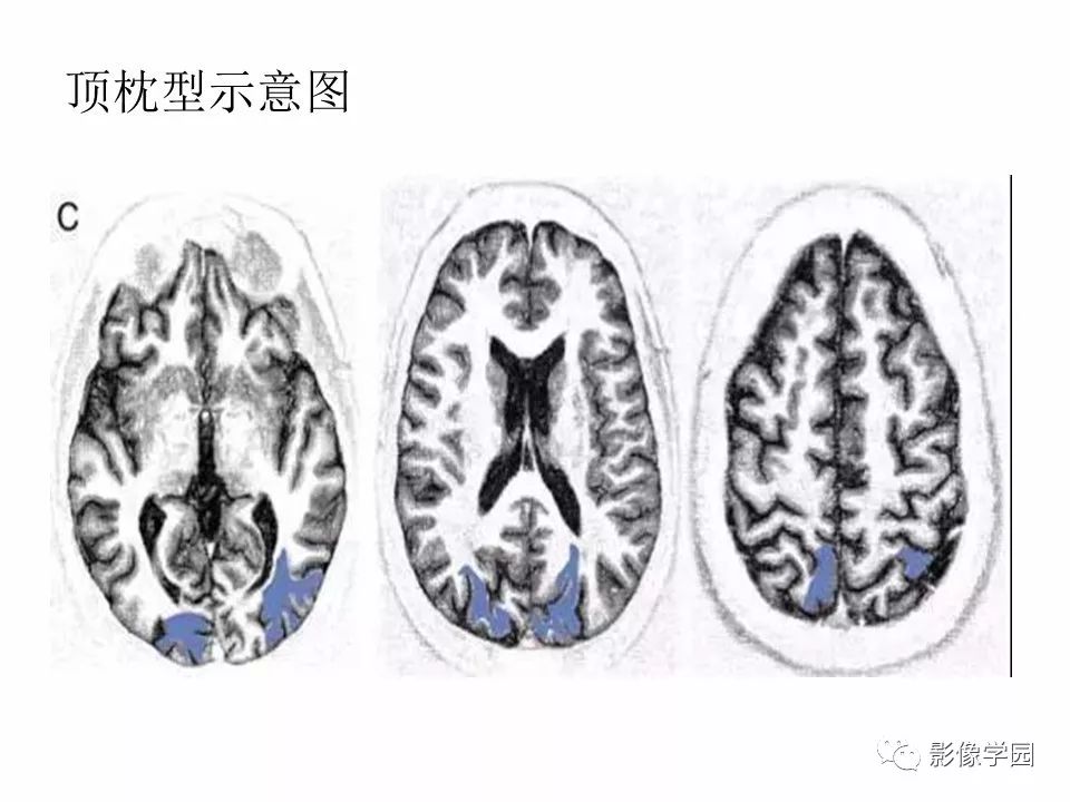 可逆性后部脑病综合征 PRES 可逆性后部脑病综合征 PRES