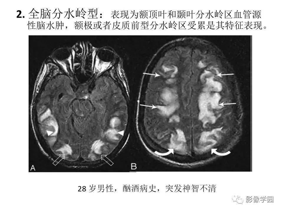 可逆性后部脑病综合征 PRES 可逆性后部脑病综合征 PRES