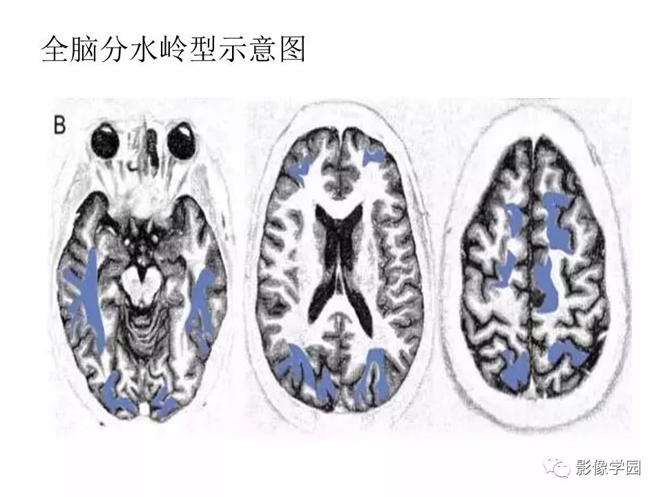 可逆性后部脑病综合征 PRES 可逆性后部脑病综合征 PRES