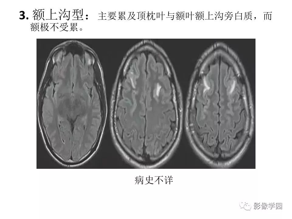 可逆性后部脑病综合征 PRES 可逆性后部脑病综合征 PRES