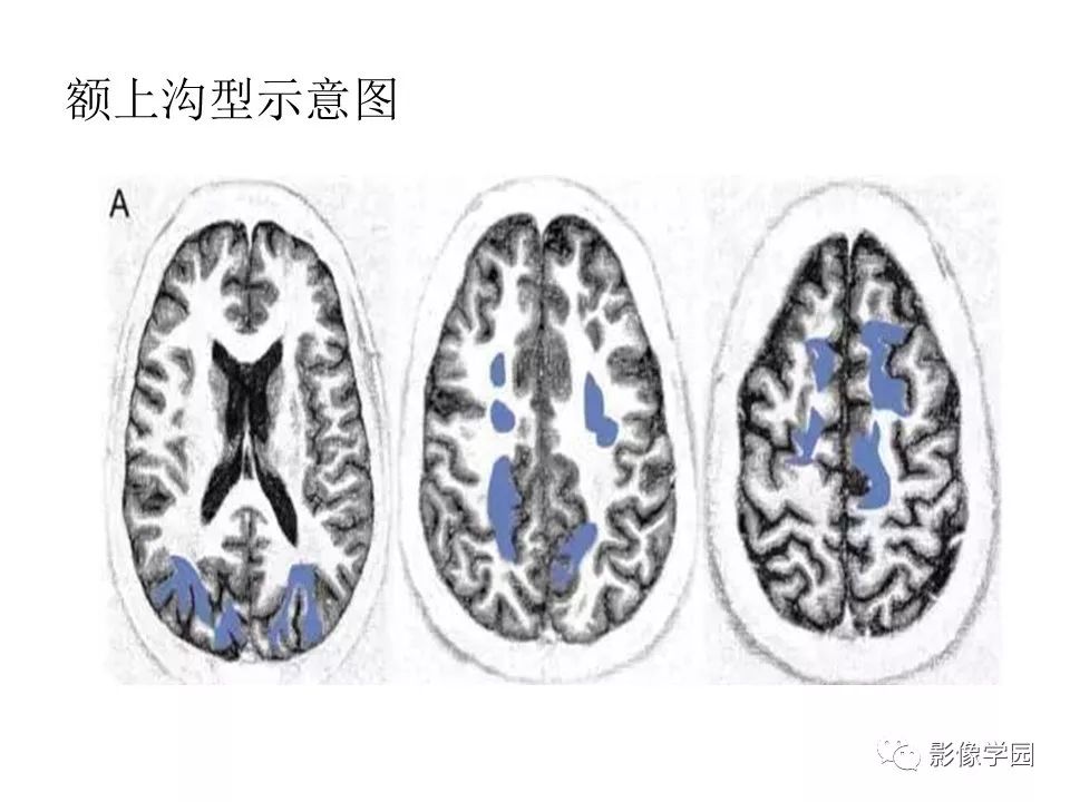 可逆性后部脑病综合征 PRES 可逆性后部脑病综合征 PRES