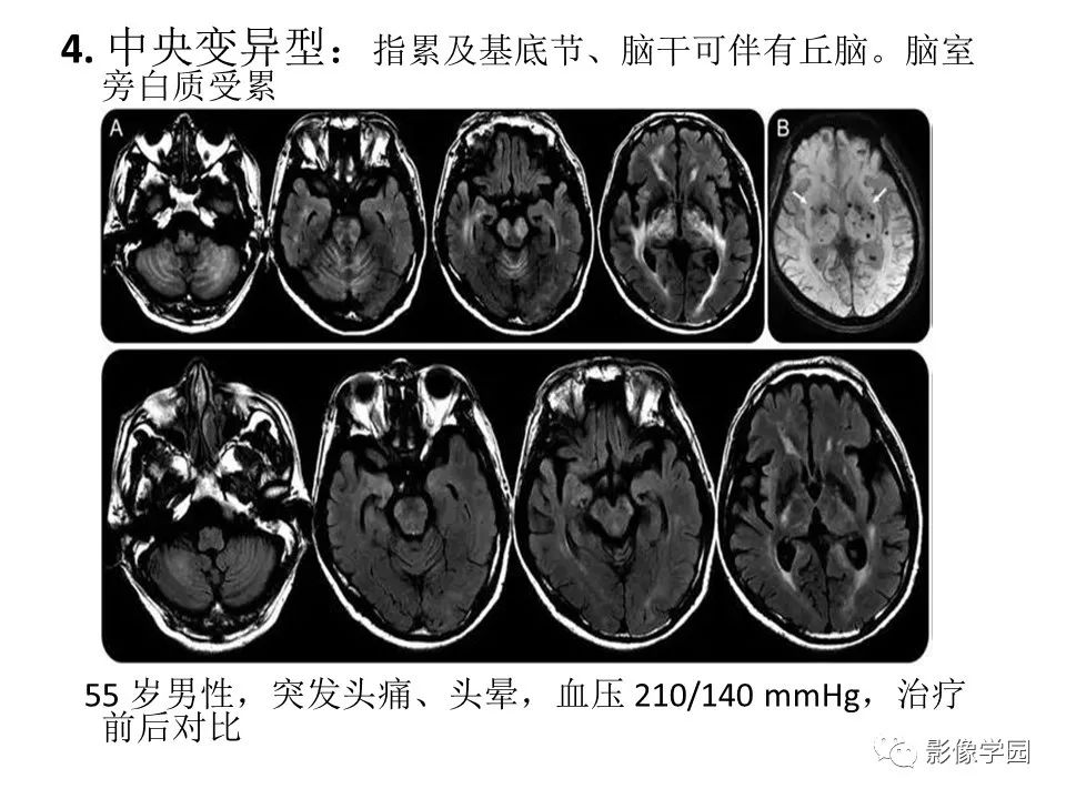 可逆性后部脑病综合征 PRES 可逆性后部脑病综合征 PRES
