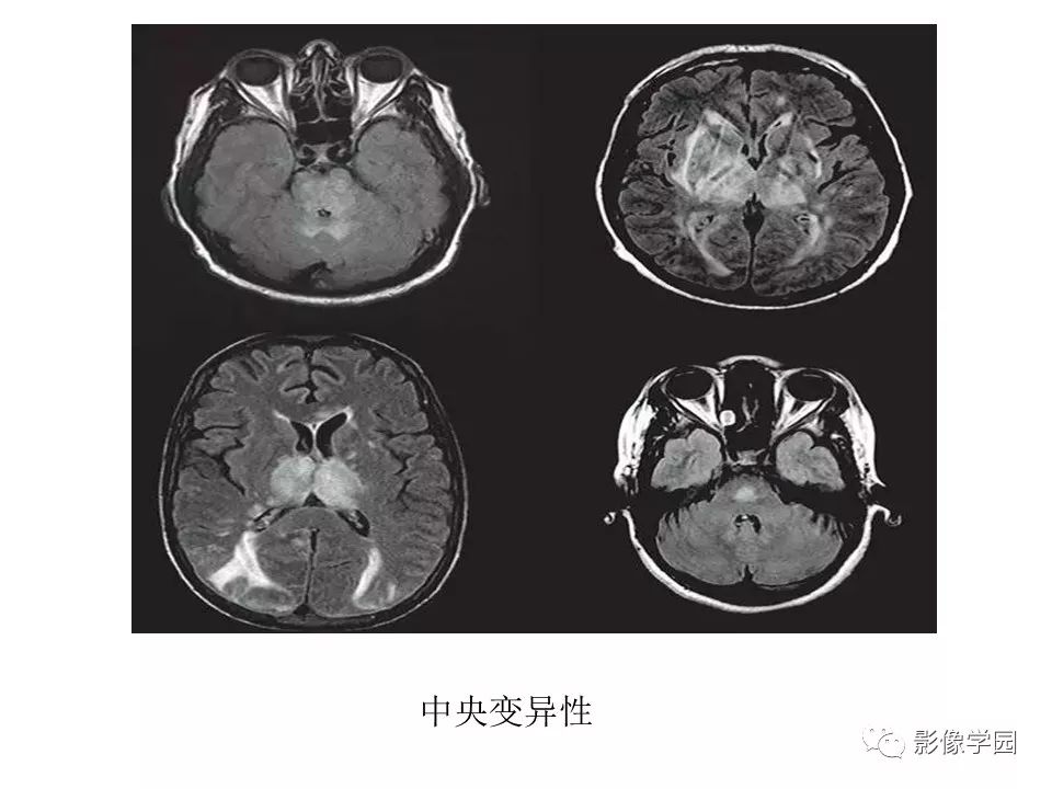 可逆性后部脑病综合征 PRES 可逆性后部脑病综合征 PRES