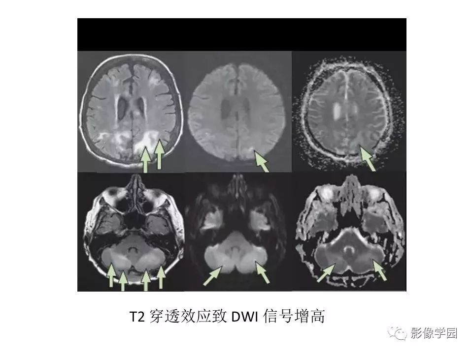 可逆性后部脑病综合征 PRES 可逆性后部脑病综合征 PRES