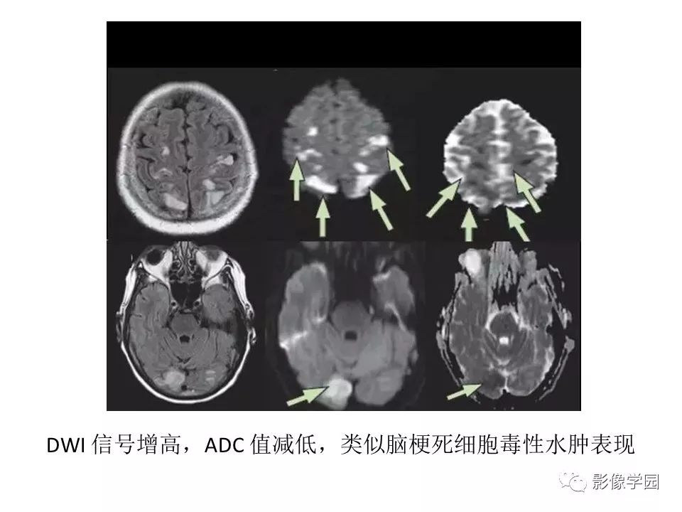 可逆性后部脑病综合征 PRES 可逆性后部脑病综合征 PRES