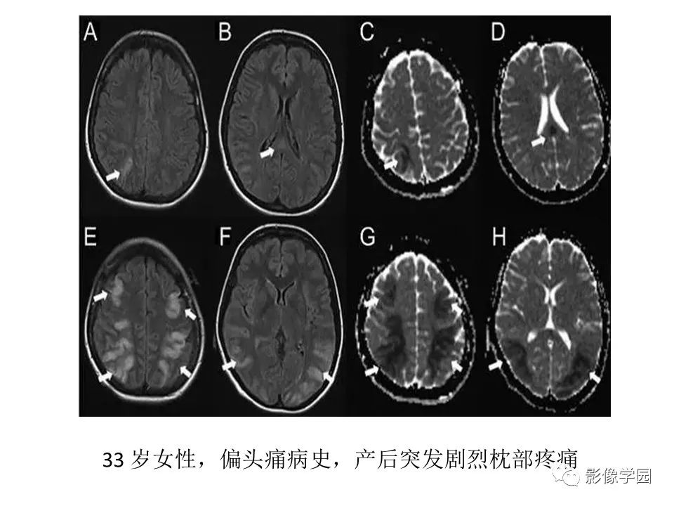 可逆性后部脑病综合征 PRES 可逆性后部脑病综合征 PRES